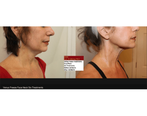 venus-freeze-before-and-after | Dolce Vida Med Spa | Westport, CT | Trumbull, CT