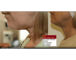 venus-freeze-before-and-after | Dolce Vida Med Spa | Westport, CT | Trumbull, CT