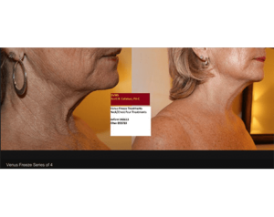 venus-freeze-before-and-after | Dolce Vida Med Spa | Westport, CT | Trumbull, CT