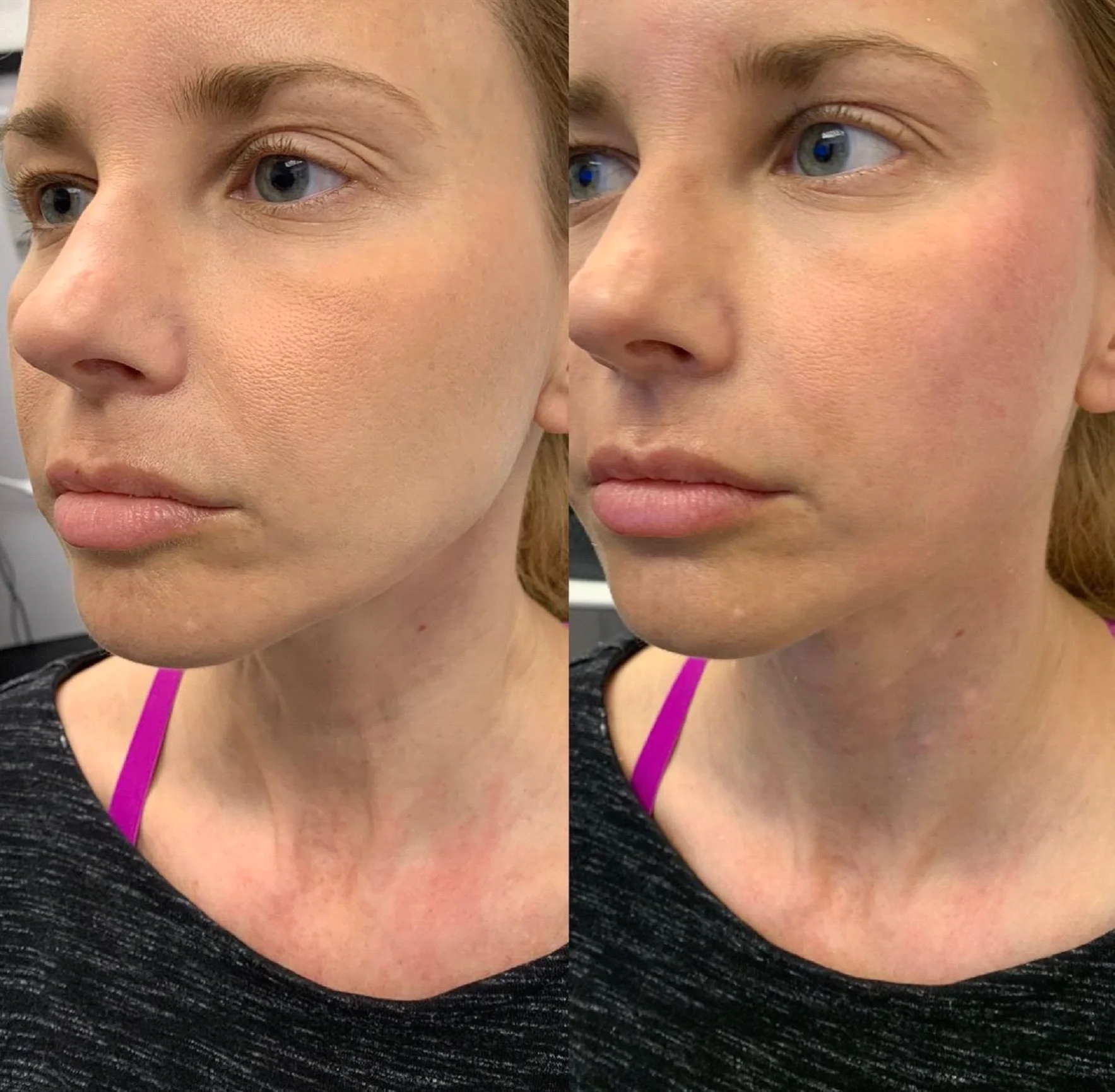 Before And After Results | Dolce Vida Medical Spa In CT